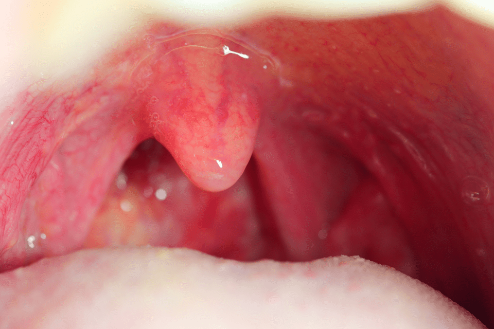 Tonsils and Adenoid